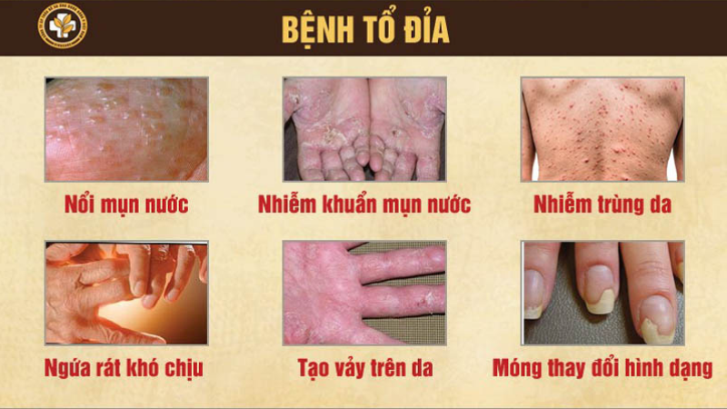 nguyên nhân bệnh tổ đỉa