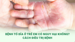 bệnh tổ đỉa ở trẻ em