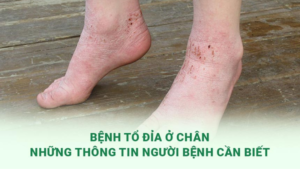 bệnh tổ đỉa ở chân