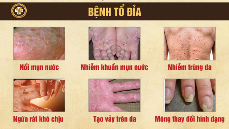 triệu chứng bệnh tổ đỉa