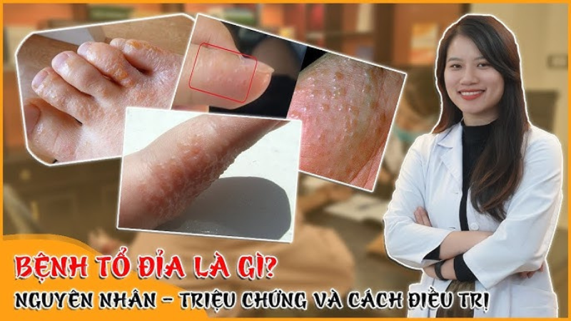 triệu chứng bệnh tổ đỉa