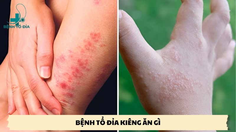 bệnh tổ đỉa kiêng ăn gì