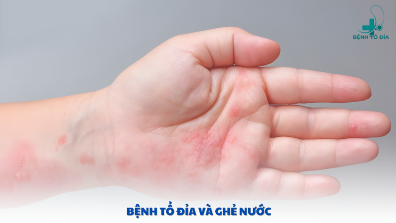 bệnh tổ đỉa và ghẻ nước