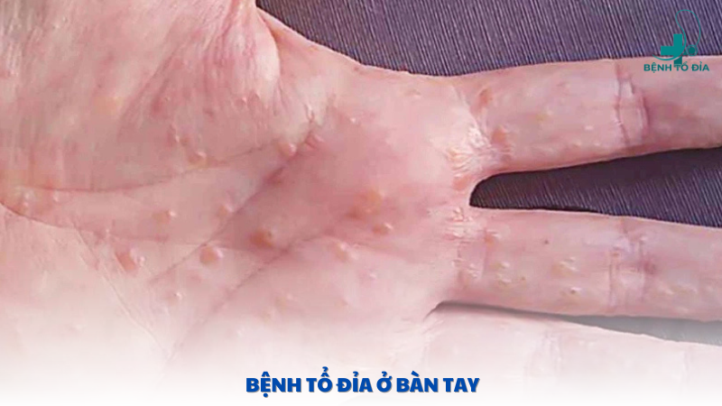 bệnh tổ đỉa ở bàn tay